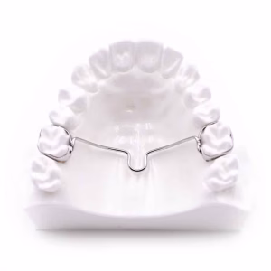 Transpalatal arch (TPA) with molar bands on a model of the upper arch