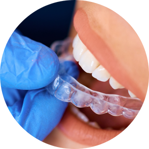 Pressure Formed Appliances » Wimbledon Orthodontic