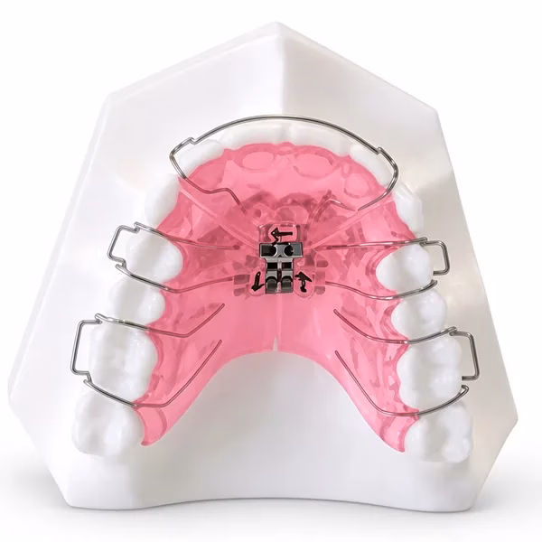 Upper removable appliance (URA) with pink acrylic baseplate, midline expansion screw and Adams clasps on an upper model, lab-made for orthodontists
